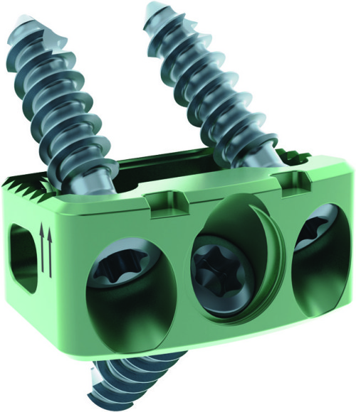 CHESAPEAKE Cervical Product Image